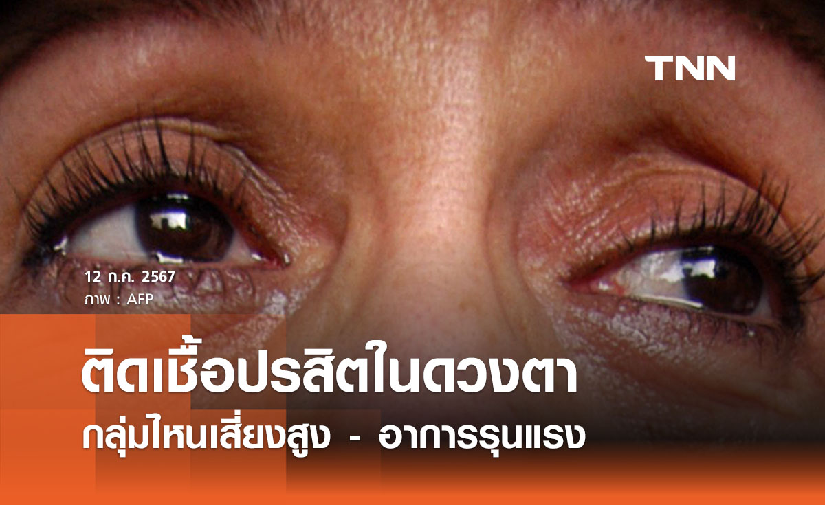 กรณีศึกษา “ตาติดเชื้อปรสิตในคอนโด” สธ. เผยกลุ่มไหนเสี่ยงสูง - อาการรุนแรง