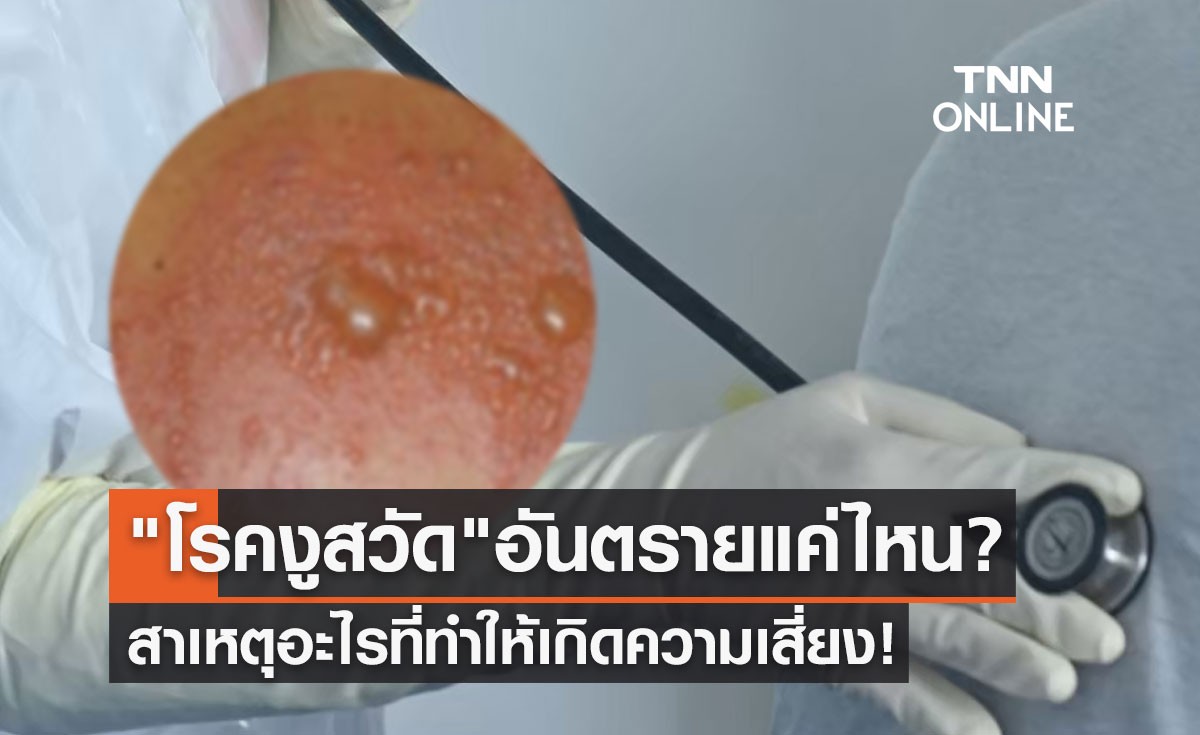 โรคงูสวัด อันตรายมากแค่ไหน? สาเหตุอะไรที่ทำให้เกิดความเสี่ยง!