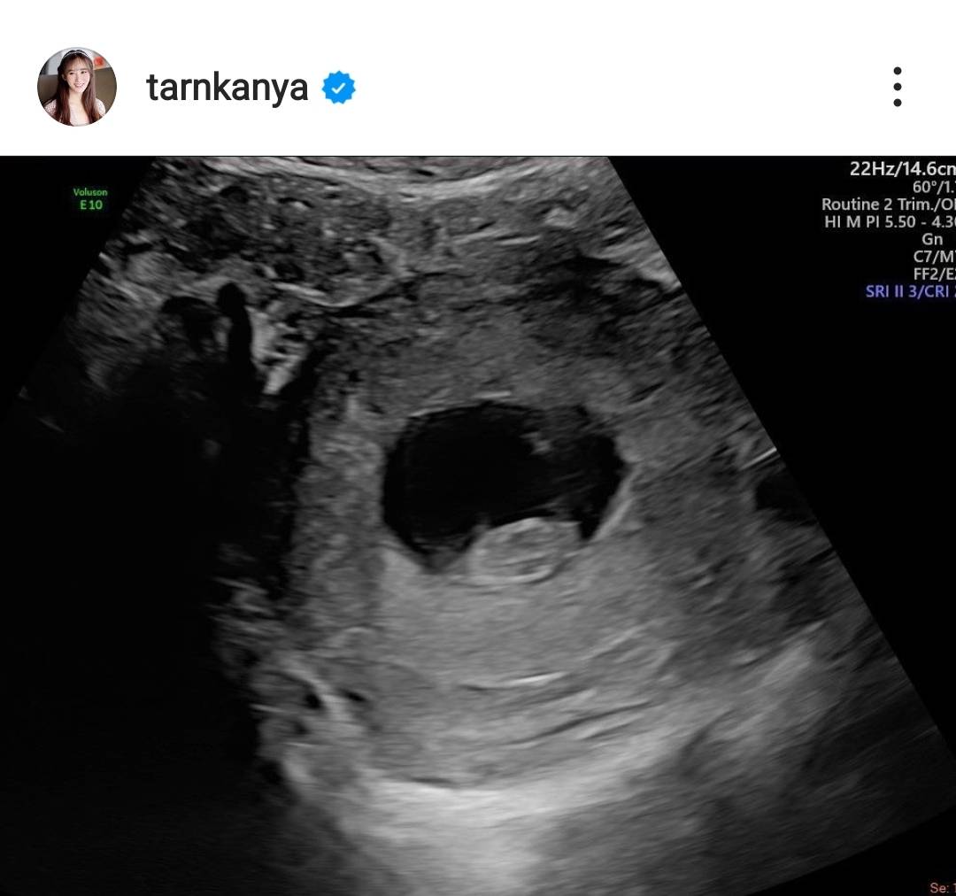 ตาล กัญญา ประกาศตั้งครรภ์ลูกคนแรกแล้ว