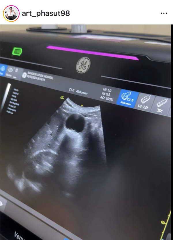 อาร์ต พศุตม์ ต้องแอดมิทเข้ารพ.ด่วน! เผยสาเหตุเป็นเรื่องที่หลายคนมองข้าม? อาร์ต พศุตม์ ต้องแอดมิทเข้ารพ.ด่วน! เผยสาเหตุเป็นเรื่องที่หลายคนมองข้าม?