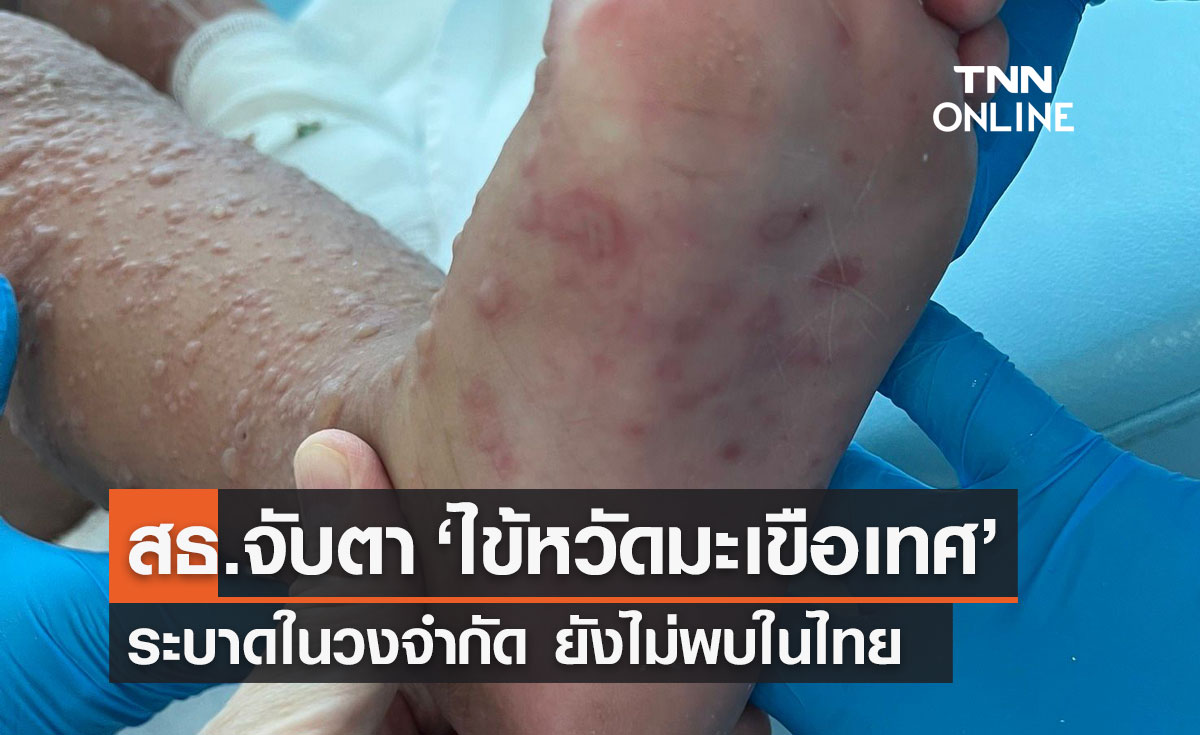 สธ.จับตา "ไข้หวัดมะเขือเทศ" อาการคล้าย "มือเท้าปาก" ในเด็ก ไม่ใช่โรคชนิดใหม่
