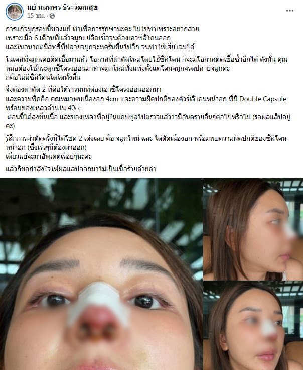 เจอเนื้องอก 4 cm หญิงแย้ เผยผ่าตัดครั้งนี้ได้โชค 2 เด้ง ลั่น! แก้จมูกไม่ใช่เพราะอยากสวย