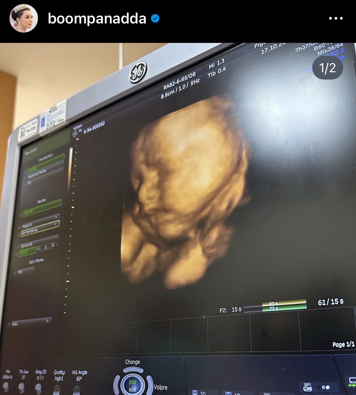 บุ๋ม ปนัดดา เผยภาพลูกชายครั้งแรก หน้าเหมือนใคร??