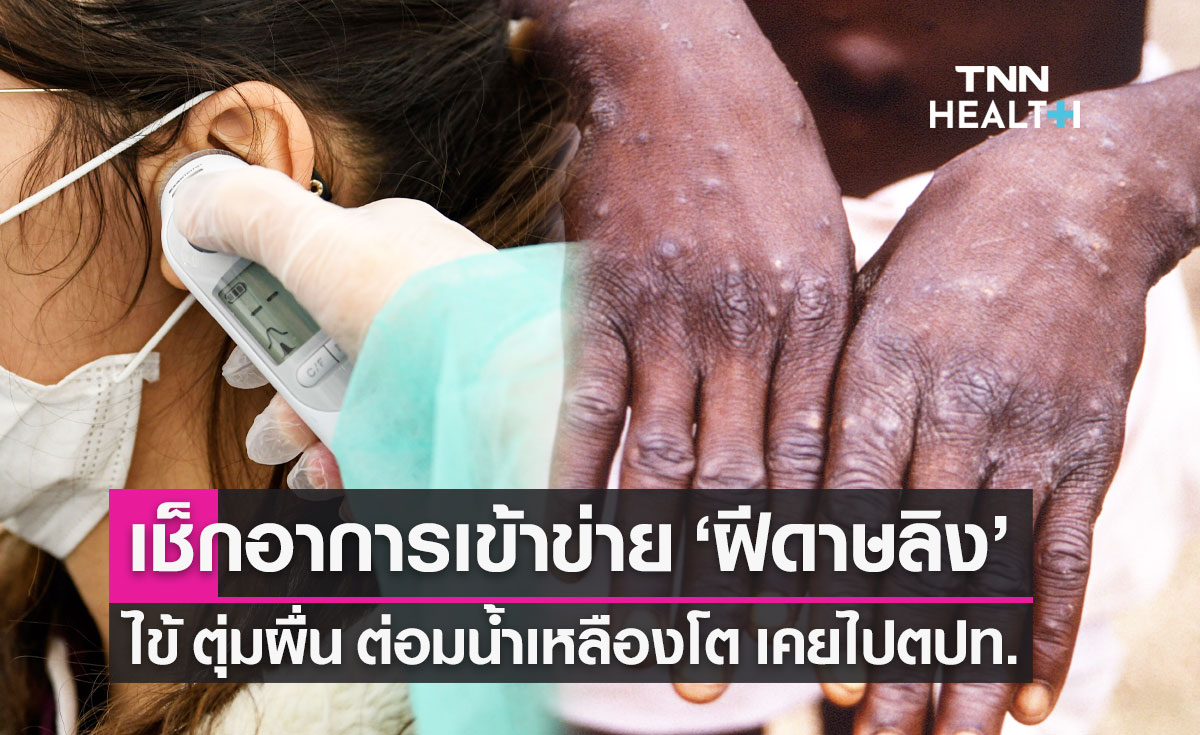 แนวทางคัดกรองผู้ป่วย "ฝีดาษลิง" อาการไข้ มีผื่นขึ้น ต่อมน้ำเหลืองโต เดินทางตปท.