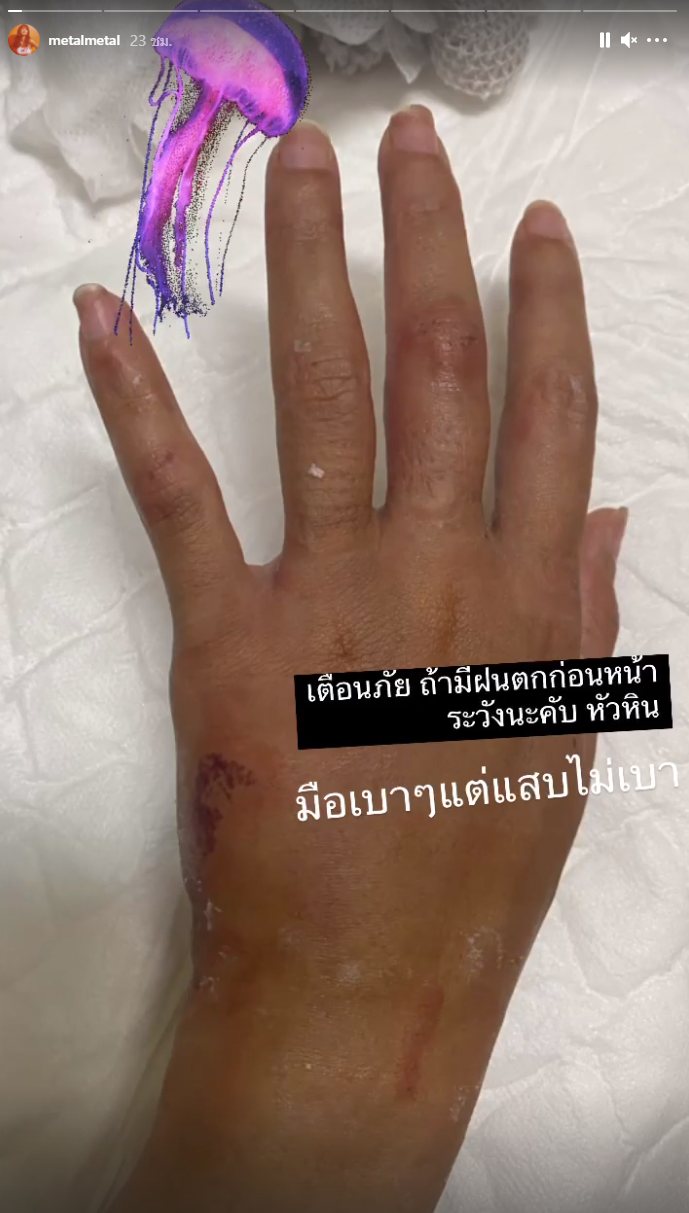 'เมทัล' โดนแมงกะพรุนไฟเล่นงาน จนเป็นแผลไหม้ทั้งแขน-ขา