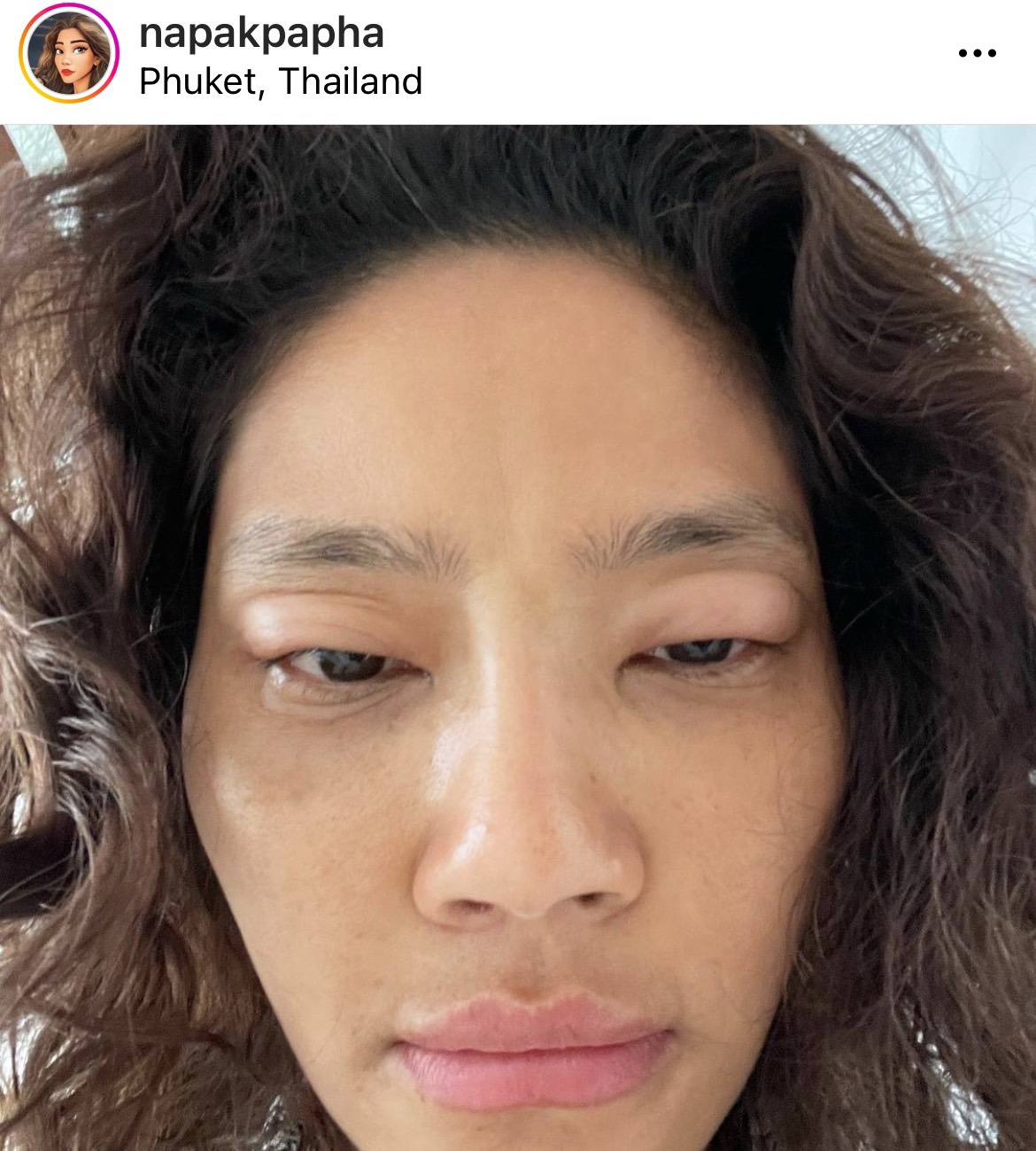 มะหมี่ นภคปภา เกิดอาการแพ้น้ำยาซักผ้ารุนแรง ถึงขั้นหายใจไม่ออก ตาบวม มะหมี่ นภคปภา เกิดอาการแพ้น้ำยาซักผ้ารุนแรง ถึงขั้นหายใจไม่ออก ตาบวม