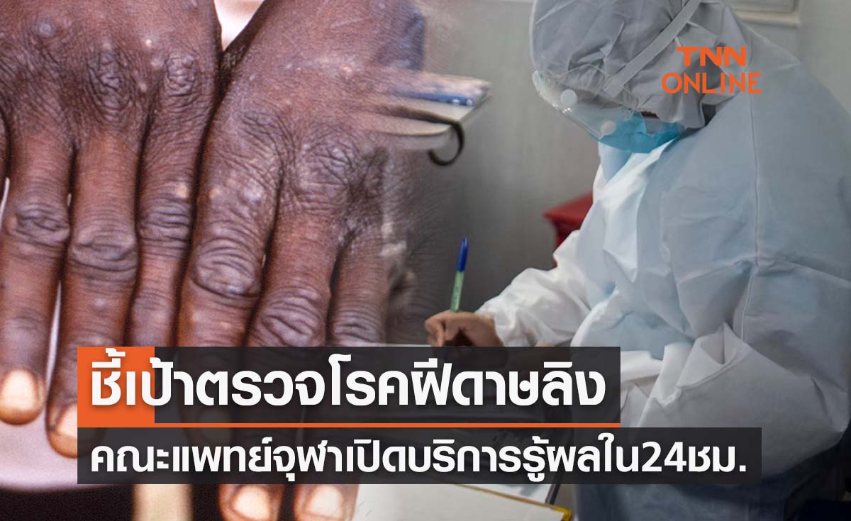 ชี้เป้าตรวจ 'โรคฝีดาษลิง' คณะแพทย์จุฬาฯแจ้งผลใน 24 ชม. 