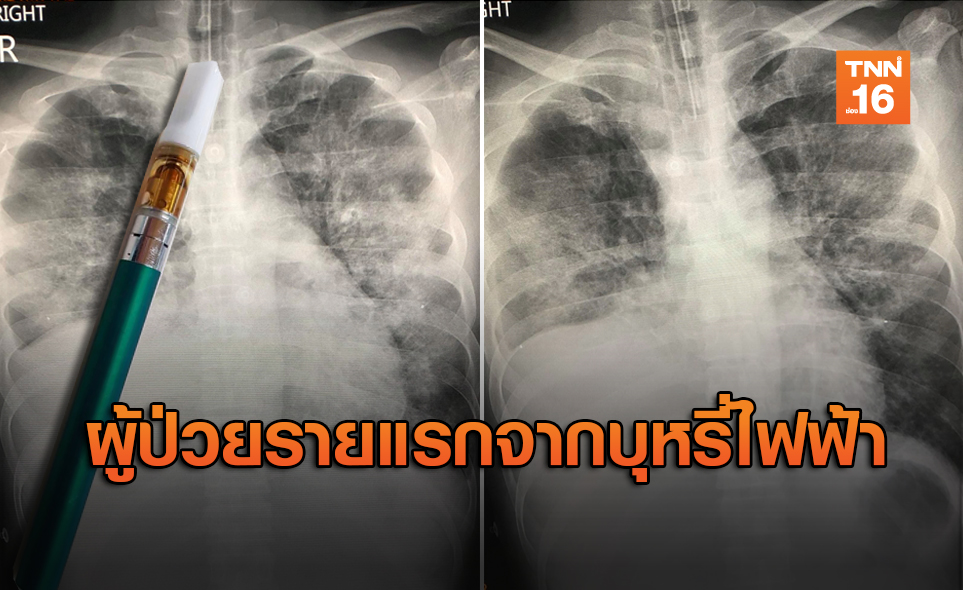 พบผู้ป่วยไทยรายแรก ปอดอักเสบ หลังสูบสารกัญชาด้วยบุหรี่ไฟฟ้า