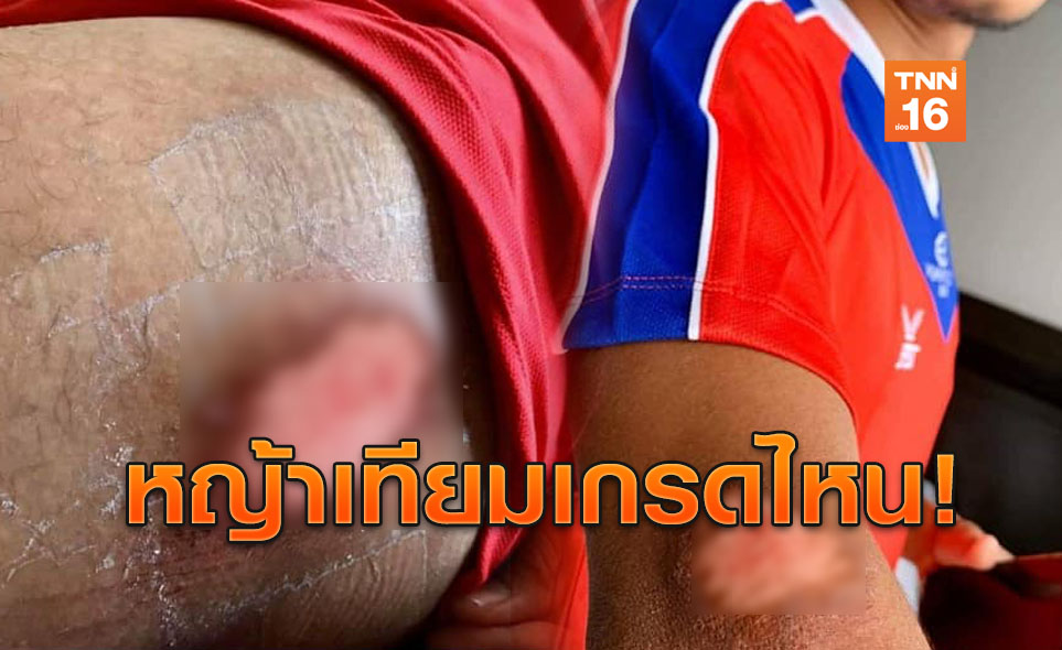 แข้งไทยต้องระวัง! ส.บอลกัมพูชา เปิดภาพนักเตะแผลเพียบจากซีเกมส์