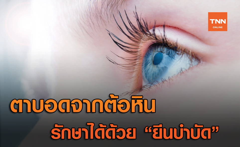รักษาอาการตาบอด จากโรคต้อหิน ได้ด้วย ยีนบำบัด (Gene Therapy)